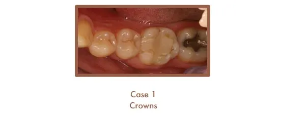 Before image of crowns