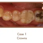 Before image of crowns