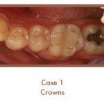 Before image of crowns