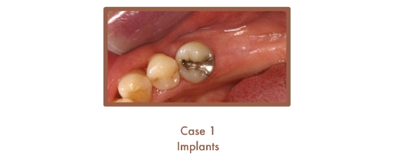 Before image of implants