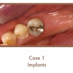 Before image of implants