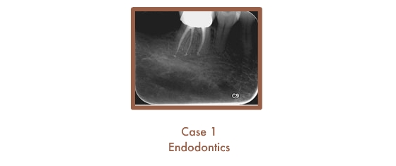 Endodontics Case Study