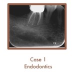 Endodontics Case Study