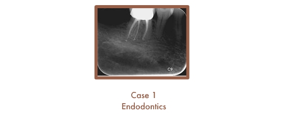 Endodontics Case Study