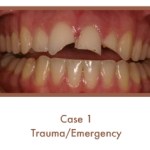 Before image of a dental emergency