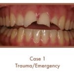 Before image of a dental emergency