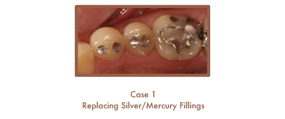 Before and After images of fillings