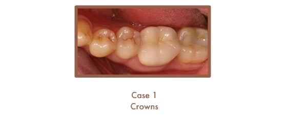 After image of crowns