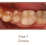 After image of crowns