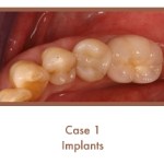 After image of implants