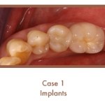After image of implants