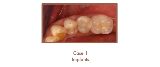 After image of implants