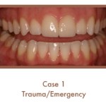 After image of a dental emergency