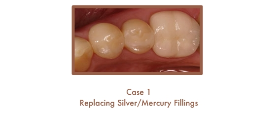 Before and After images of fillings