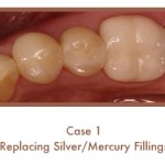 Before and After images of fillings