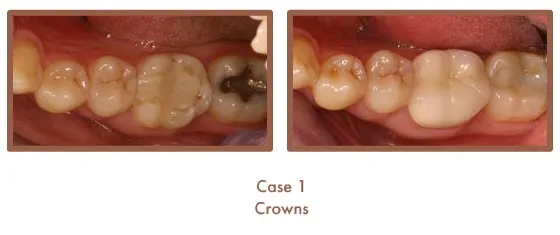 Before and after image of crowns