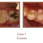 Before and after image of crowns