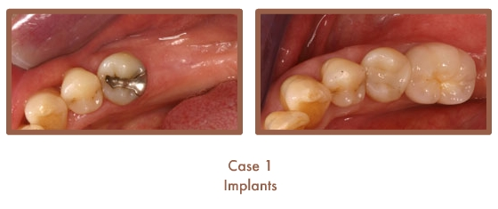 Before and after image of implants