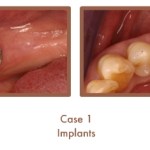 Before and after image of implants