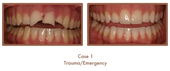Before and After image of a dental emergency