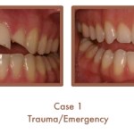 Before and After image of a dental emergency