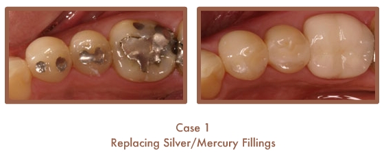 Before and After images of fillings