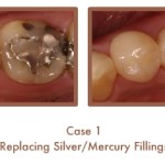 Before and After images of fillings