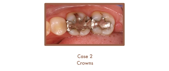 Before image of crowns