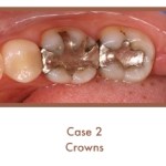 Before image of crowns