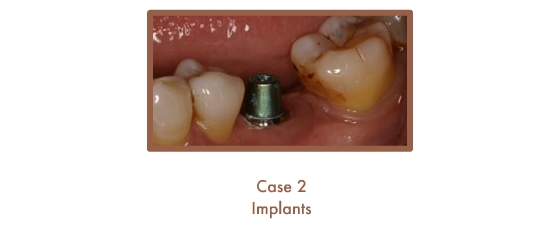 Before image of implants
