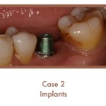 Before image of implants
