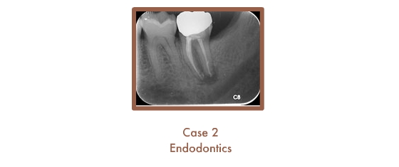 Endodontics Case Study