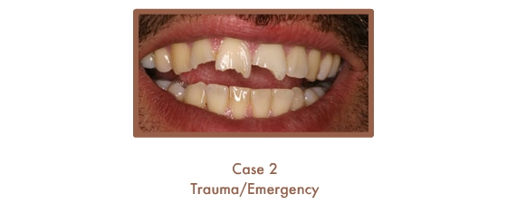 Before image of a dental emergency