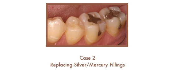 Before and After images of fillings