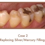 Before and After images of fillings