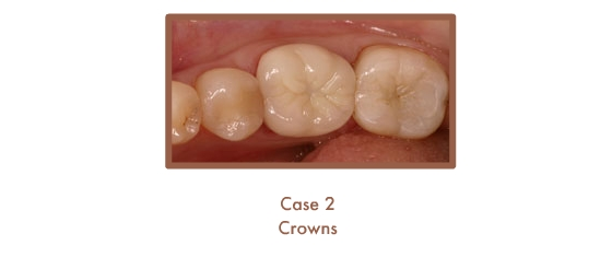 After image of crowns