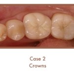 After image of crowns