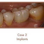 After image of implants