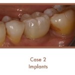 After image of implants