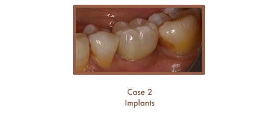 After image of implants