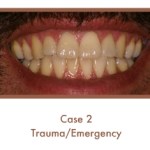 After image of a dental emergency