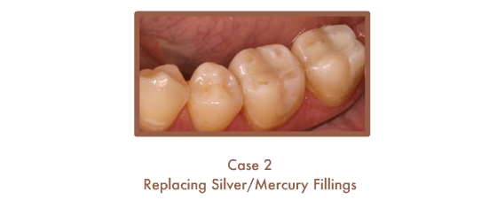 Before and After images of fillings