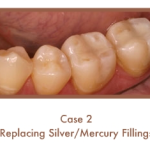 Before and After images of fillings