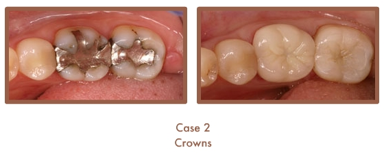 Before and after image of crowns