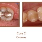 Before and after image of crowns
