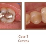 Before and after image of crowns