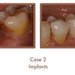 Before and after image of implants