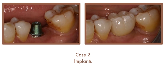 Before and after image of implants