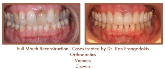 Reconstruction Case Study