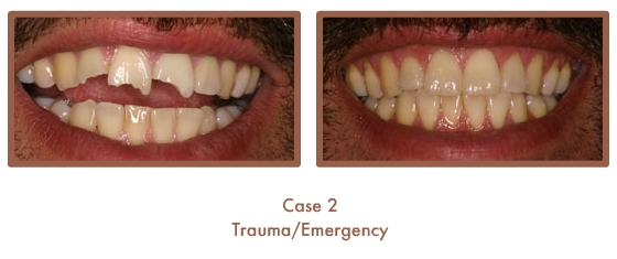 Before and After image of a dental emergency